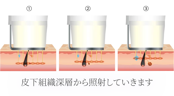 皮下組織から照射していきます