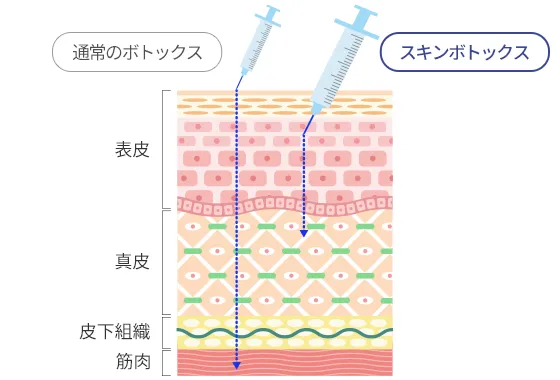 スキンボトックスの注入する層